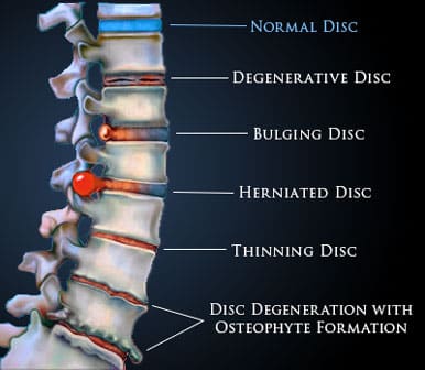 Degenerative disc disease in Clermont