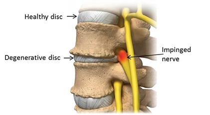 Symptoms of a Pinched Nerve