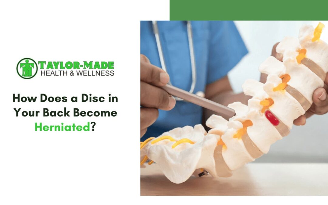 How Does a Disc in Your Back Become Herniated?